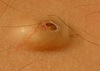 cyst